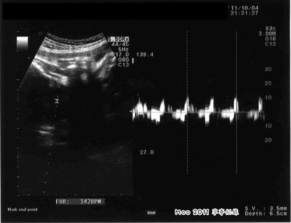 小小手超音波記錄-1004-4