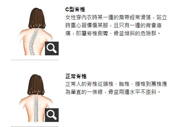 C型脊椎