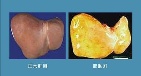 共病-NAFLD_真實比較圖.jpg