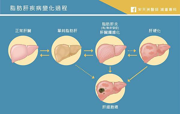 共病-NAFLD_變化過程.jpg