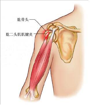 biceps tendinitis.jpg