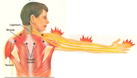 cervical refer pain.jpg