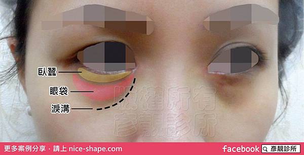 桃園-台北-醫美-推薦-彥靚診所-眼袋-淚溝-黑眼圈-玻尿酸-消除眼袋-消除淚溝-長效型玻尿酸-新竹1663011.jpg