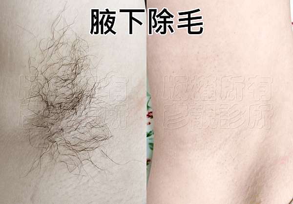 蔡學毅醫師推薦亞歷山大永久雷射除毛 雷射美白腋下私密處亮白分享 微整形達人蔡學毅醫師 醫學部落格 痞客邦 蔡學毅醫師推薦亞歷山大永久雷射除毛 雷射美白腋下私密處亮白分享 微整形達人蔡學毅醫師 醫學部落格 痞客邦