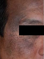 太田母斑 皮膚科劉權毅醫師 痞客邦