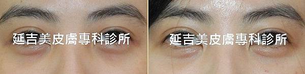 黑眼圈1 黑眼圈1