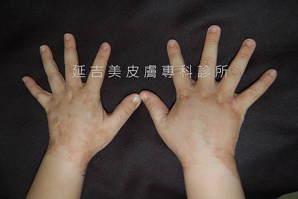 肢端型黑色棘皮症1--劉權毅醫師提供 肢端型黑色棘皮症1--劉權毅醫師提供