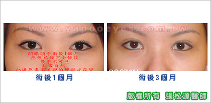 開眼頭術後1個月-3個月.jpg 開眼頭術後1個月-3個月.jpg