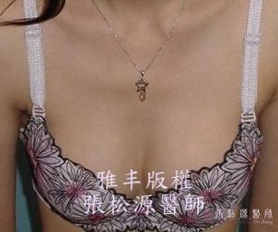 雙面複合式隆乳手術22.jpg