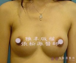 雙面複合式隆乳手術24.jpg