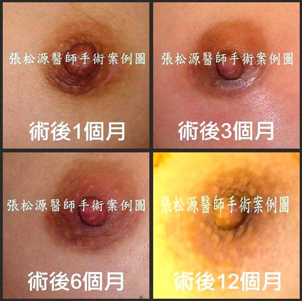 果凍矽膠隆乳手術疤痕比較4