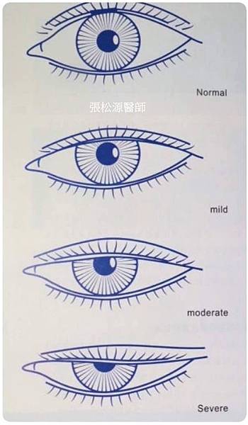 提眼瞼肌無力.jpg 提眼瞼肌無力.jpg