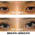 雙眼皮+提眼瞼肌手術02.jpg