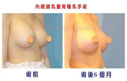 隆乳案例張松源醫師5-1.jpg