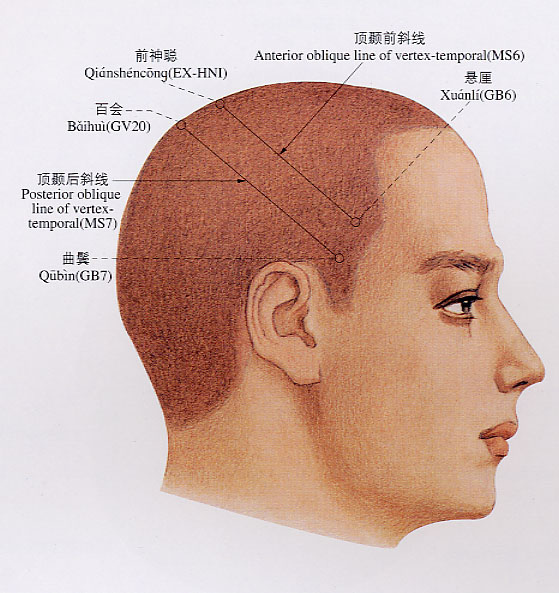 17-頭針穴線圖（頂顳區1）