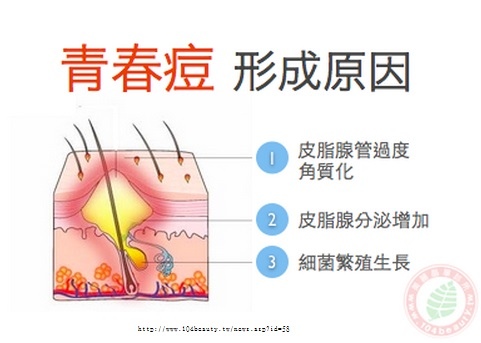 痘痘原因 痘痘原因