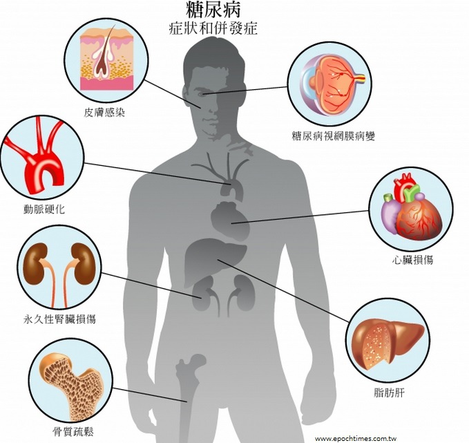 談尿病01