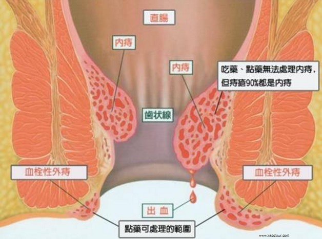 痔瘡-點藥可處理範圍.jpg