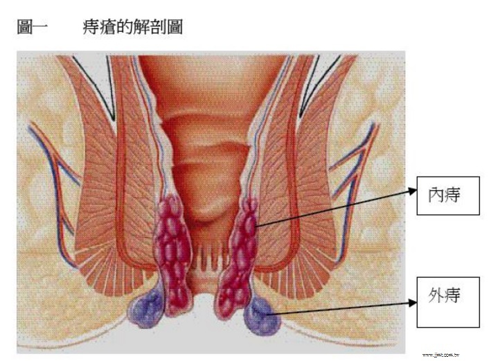 痔瘡圖1.jpg