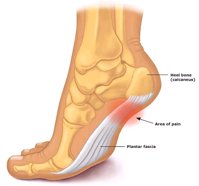 Plantar-Fasciitis