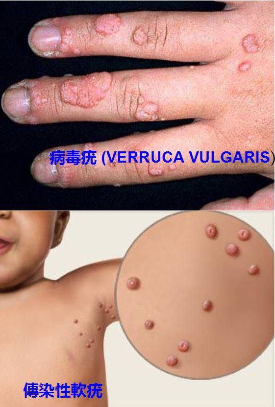 verruca