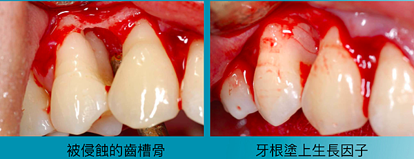 牙周組織再生01