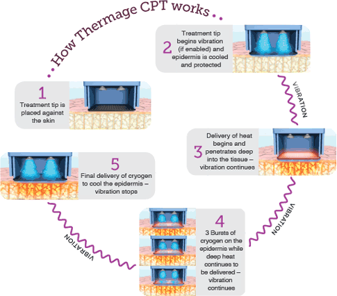 how_thermage_works_lg3