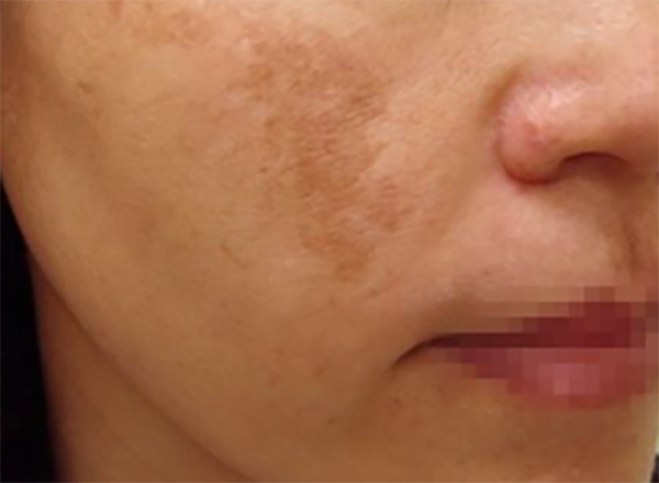 Melasma-before.png