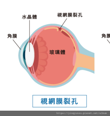 [美國就醫] 視網膜撕裂手術