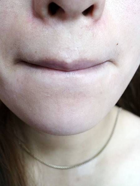 醫洗臉/飛悅皮膚科/脈衝光/除痘痘/除粉刺