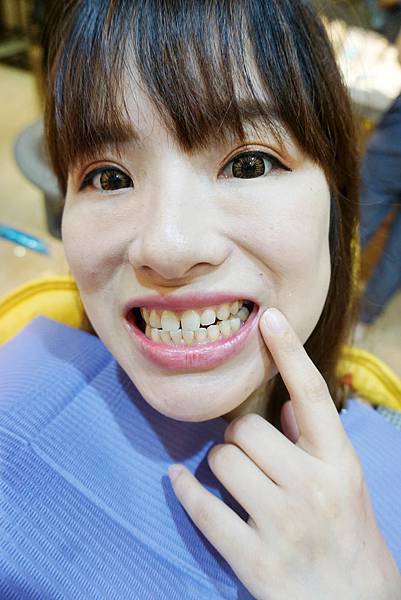 怡登牙醫推薦林葳醫師/牙齒冷光美白
