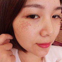 暗沉膚色不均對比