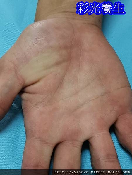 咳嗽鐵鏽味，椎間盤凸出，原生家庭創傷