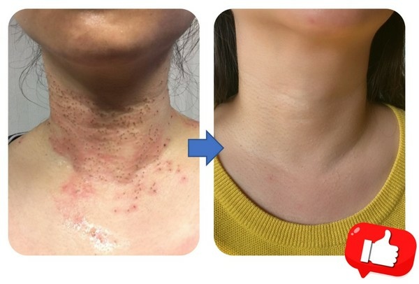 頸部顆粒去除分享～