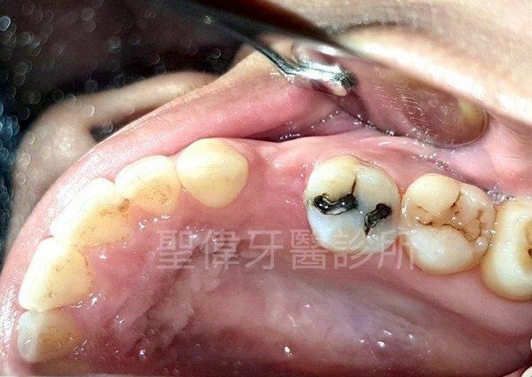 行天宮植牙診所推薦聖偉牙醫診所林院長，拖了兩年的缺牙終於補上