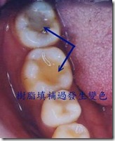 填補過發生變色