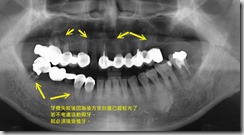 多顆植牙，避免活動假牙。-1