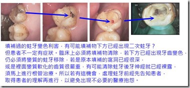 從補蛀牙變成根管治療的過程