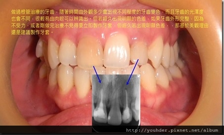 牙齒做完根管治療出現變色