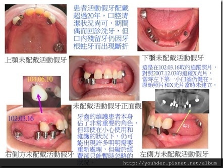 傳統活動假牙和各種設計之精密型活動假牙之比較-1