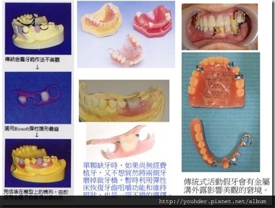 彈性床和傳統活動式假牙的比較