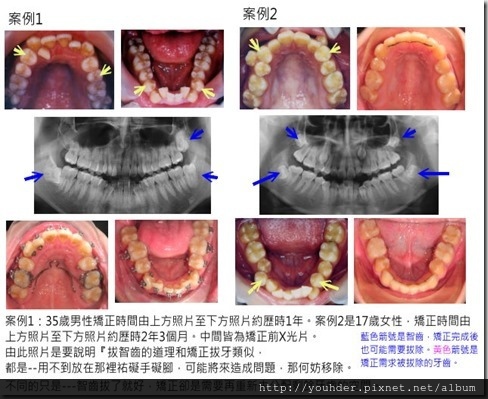 有關智齒是否該拔除說明案例