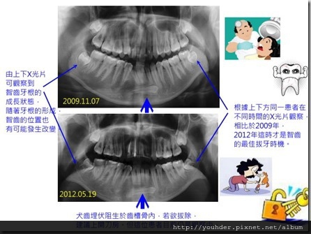 針對須手術拔除智齒的考量1