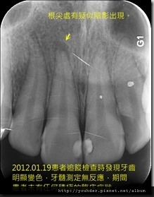 意外撞傷後引起牙髓壞死發展成根尖病變之追蹤-2