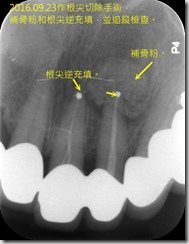 根尖切除手術-術前X光片3