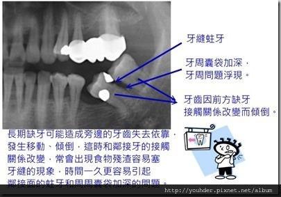 缺牙導致牙齒接觸關係改變。