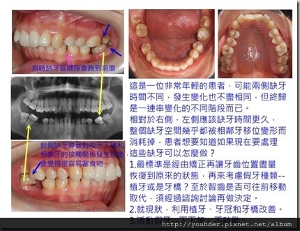 缺牙過久的後遺症實例３