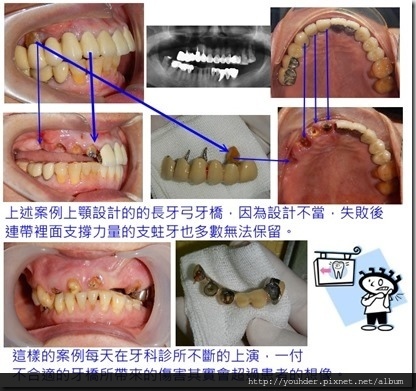 設計不當的長牙橋