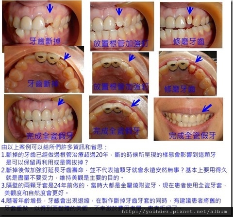 單顆斷牙做全瓷牙套