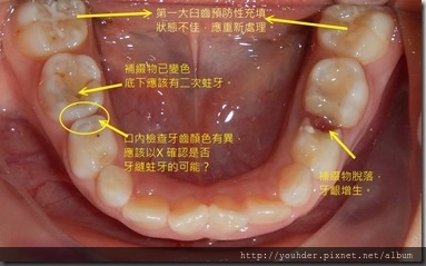 兒童口內蛀牙和補綴物變色情形